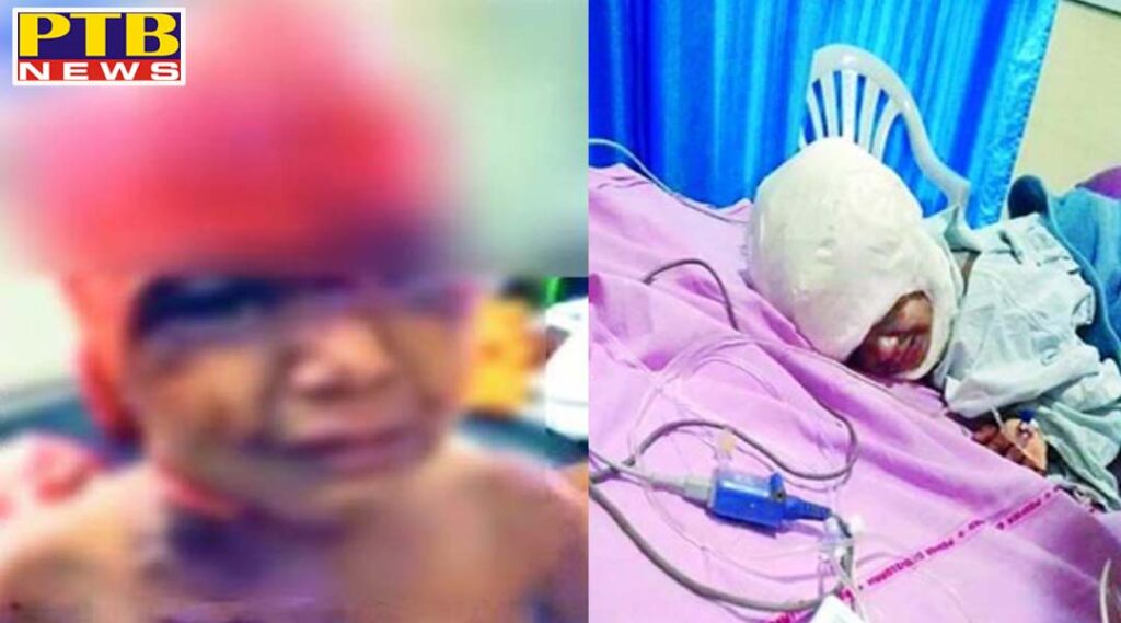 In Punjab, this 10-year-old girl has a skinned head and ears Girl critical pgi is undergoing treatment
