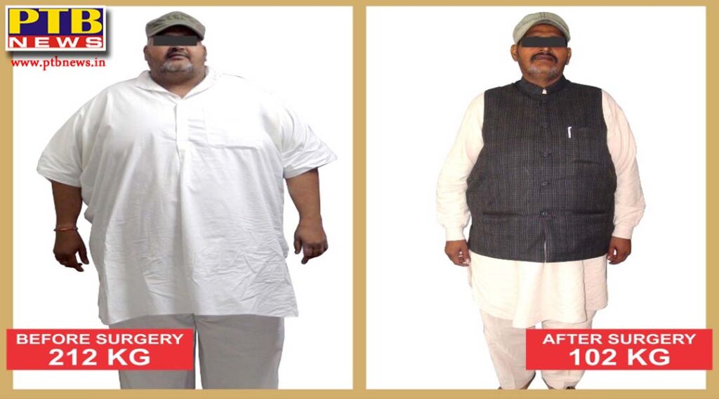 More than 100 kg can be reduced by weight, obesity Scientific treatment is bariatric surgery, Dr. GSJammu Jammu Hospital Jalandhar