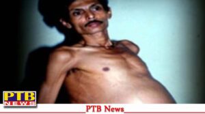 शख्‍स का पेट फुला तो लोग कहने लगे प्रेग्नेंट, ऑपरेशन के बाद निकले जुड़वाँ बच्चे,