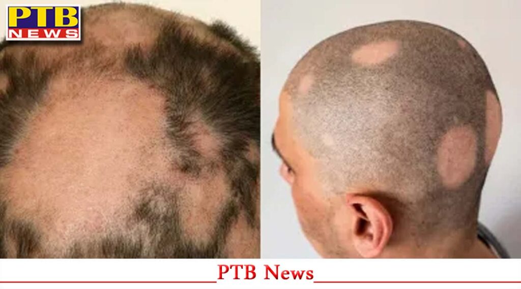 people-reached-camp-to-get-rid-of-baldness-in-sangrur-this-is-what-happened