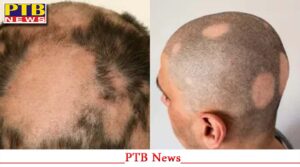 people-reached-camp-to-get-rid-of-baldness-in-sangrur-this-is-what-happened