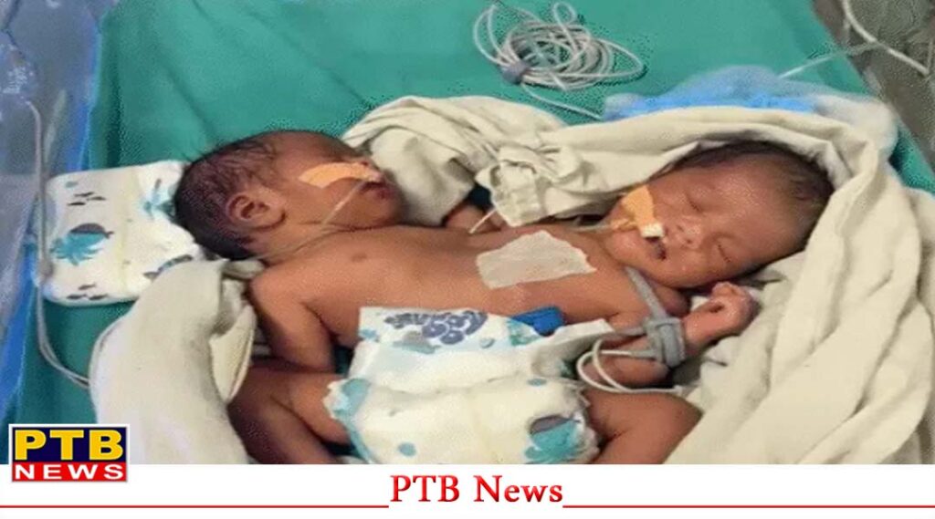 one-girl-child-was-born-with-two-hearts-two-heads-and-four-hands-people-are-considering-it-a-miracle